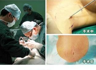 儿童患上腋臭有什么样的危害 手术过程.jpg